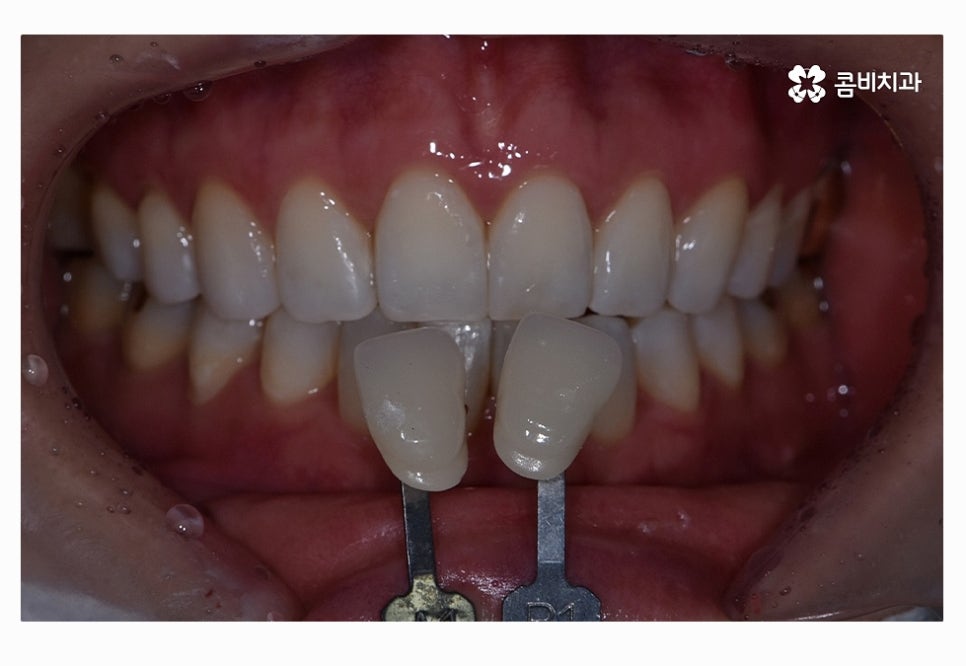 누런이로 고민하시는 분들을 위한 치아미백 정보 관련 이미지 7