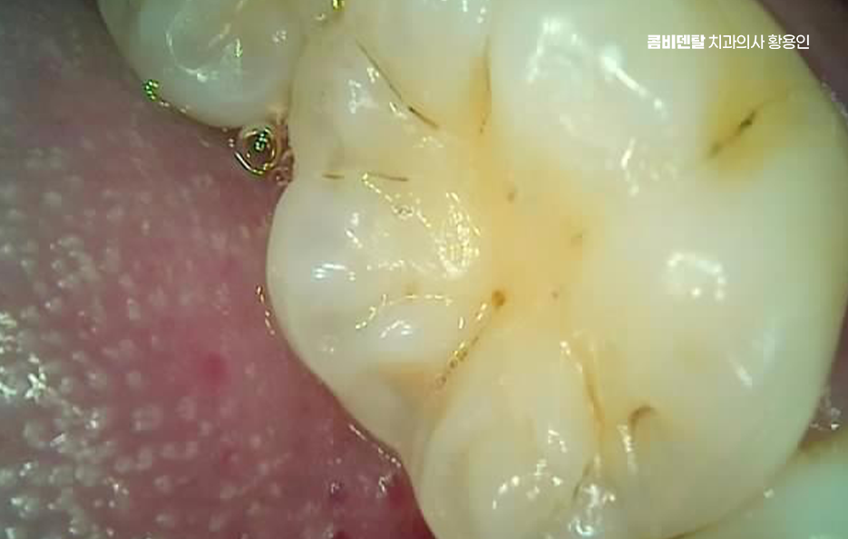 충치 검은점 나타났다면 이렇게 대처해요 관련 이미지 9