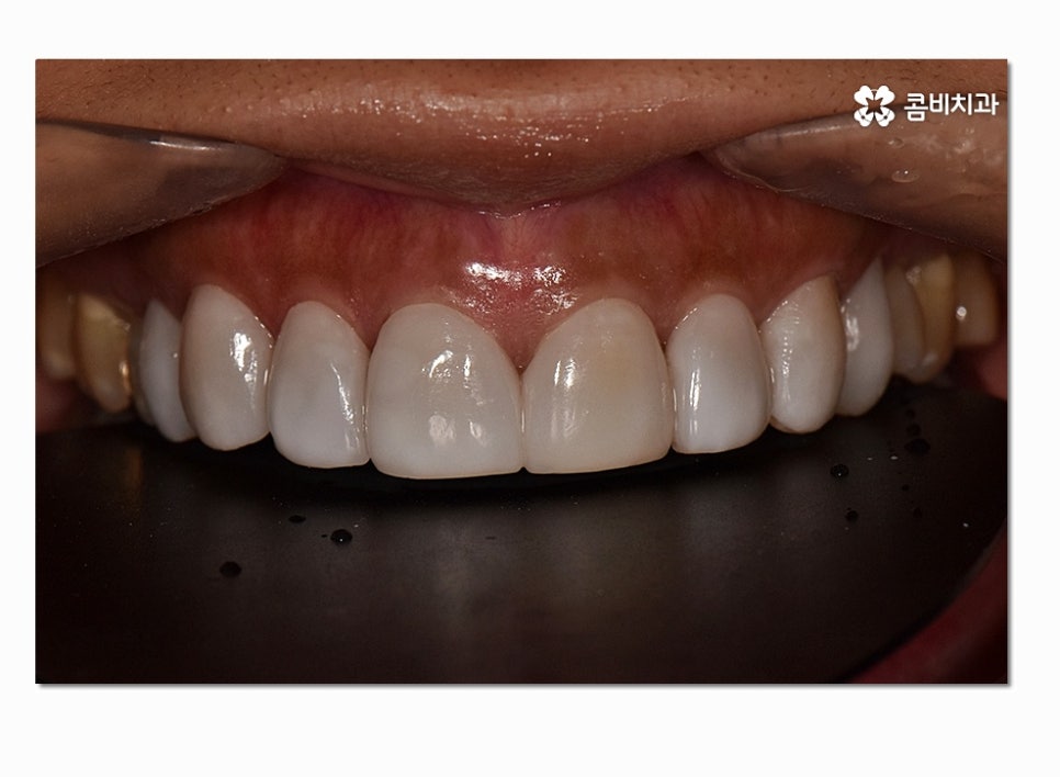 치아라미네이트 누구에게 필요할지 궁금하다면 관련 이미지 6