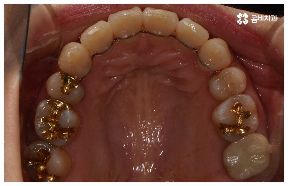 중년치아교정 원한다면 관련 이미지 19