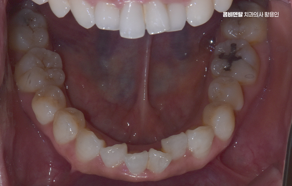 앞니 부분 교정 간단하니까 좋은건가요 관련 이미지 6