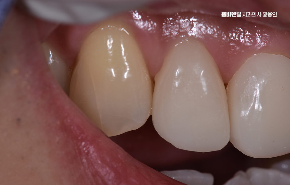 How to Use Laminate Veneers for Chipped Front Teeth image 7