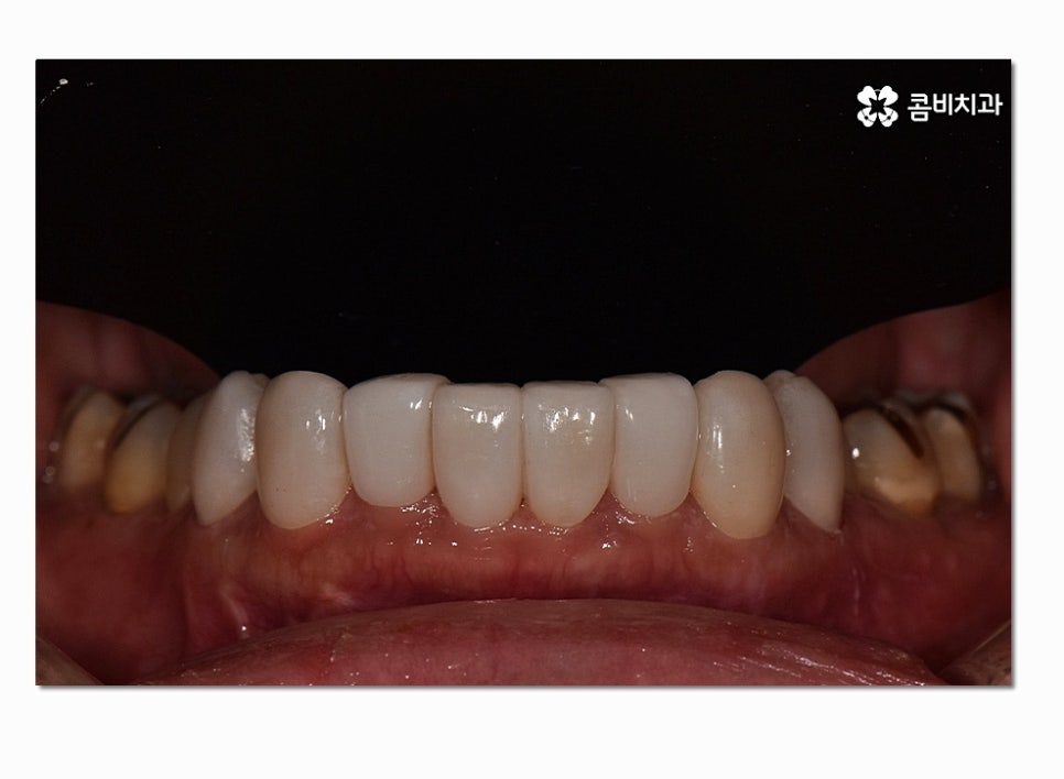 치아라미네이트 누구에게 필요할지 궁금하다면 관련 이미지 7