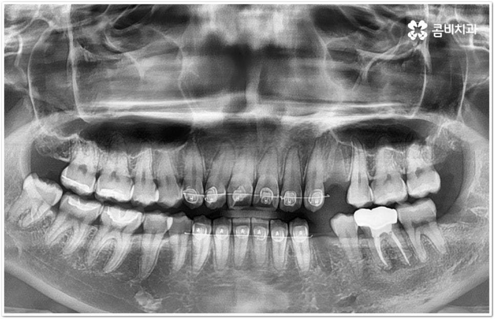 아래사랑니발치 망설이고 있다면 관련 이미지 1