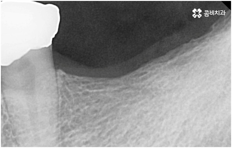 발치후 임플란트 바로 되나요? 관련 이미지 8