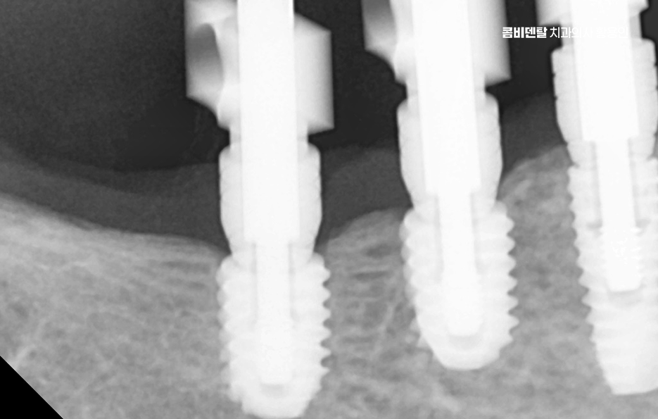 어금니 임플란트 안하면 후회하게 되는걸까 관련 이미지 5