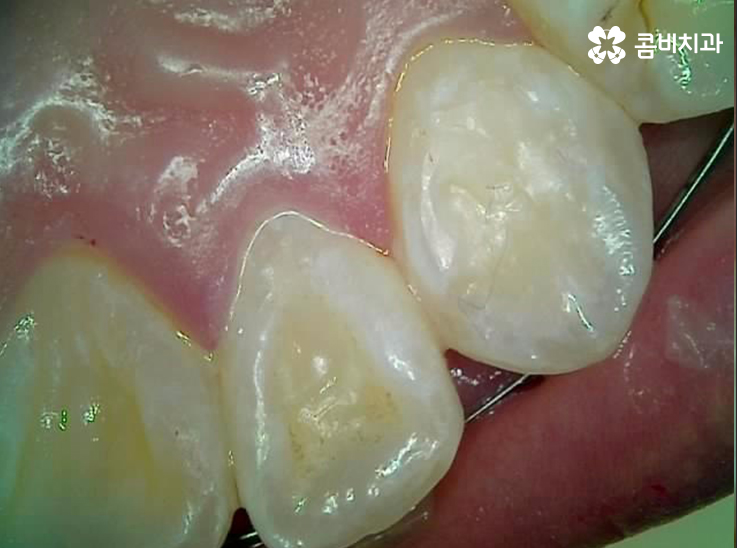 앞니 충치치료 개인에 따라 달라지는 이유 관련 이미지 7