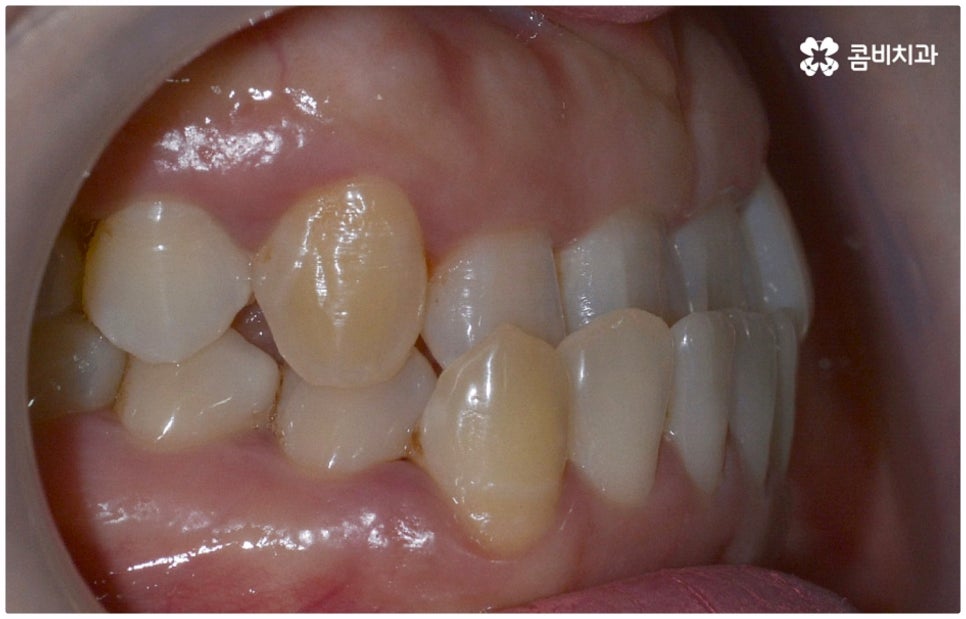 반대교합교정 늦지 않았어요 관련 이미지 4