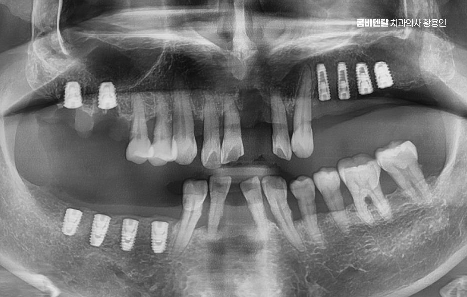 임플란트 뼈이식 안하면 어떤 문제가 있는거죠 관련 이미지 5