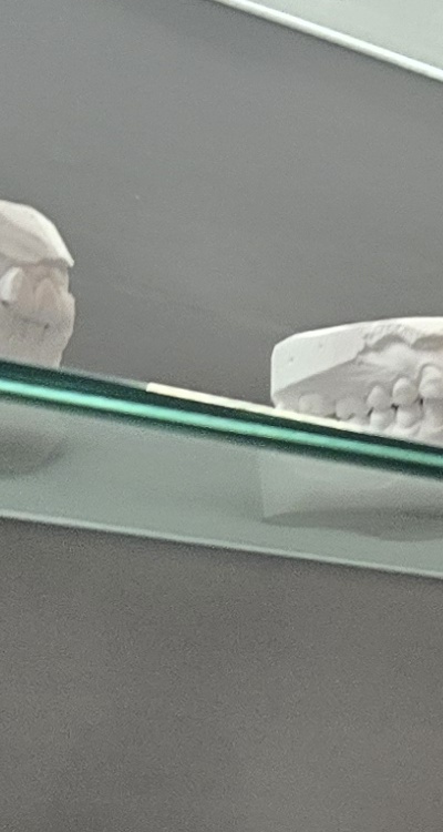 완전매복사랑니 발치 대학병원 꼭 가야하나요 관련 이미지 23