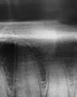 어금니 뒤 잇몸 부음 어떤 문제길래 이런거죠 관련 이미지 22