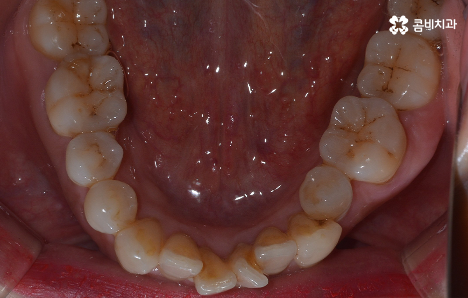 돌출입 콤비교정으로 얼굴까지 개선하는 방법은 관련 이미지 6