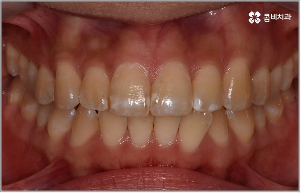 비발치치아교정 언제 할수있나요 관련 이미지 3
