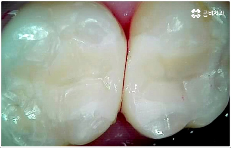 치아사이충치 놔두면 안돼요 관련 이미지 4