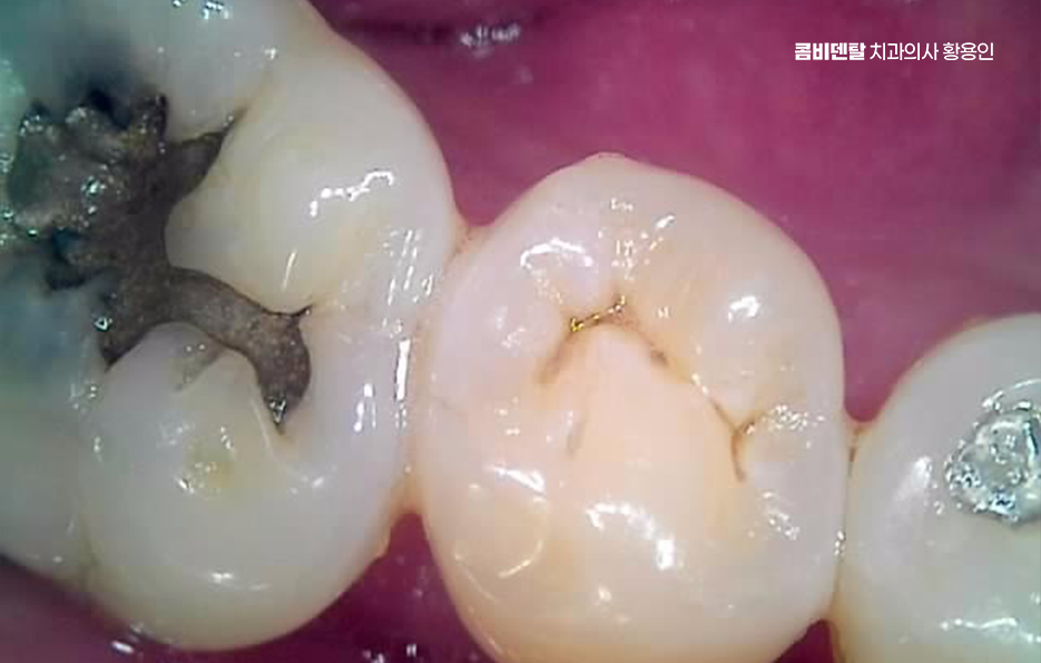 오래된 보철물 아말감 교체 어떠한 케이스일까 관련 이미지 2