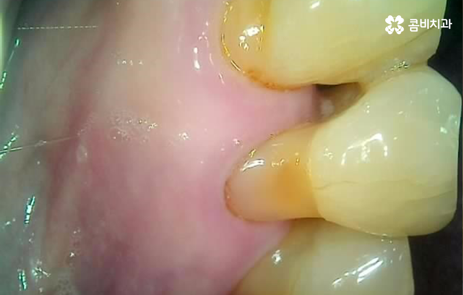 50대임플란트 각별하게 주의해야 하는 시기 관련 이미지 3