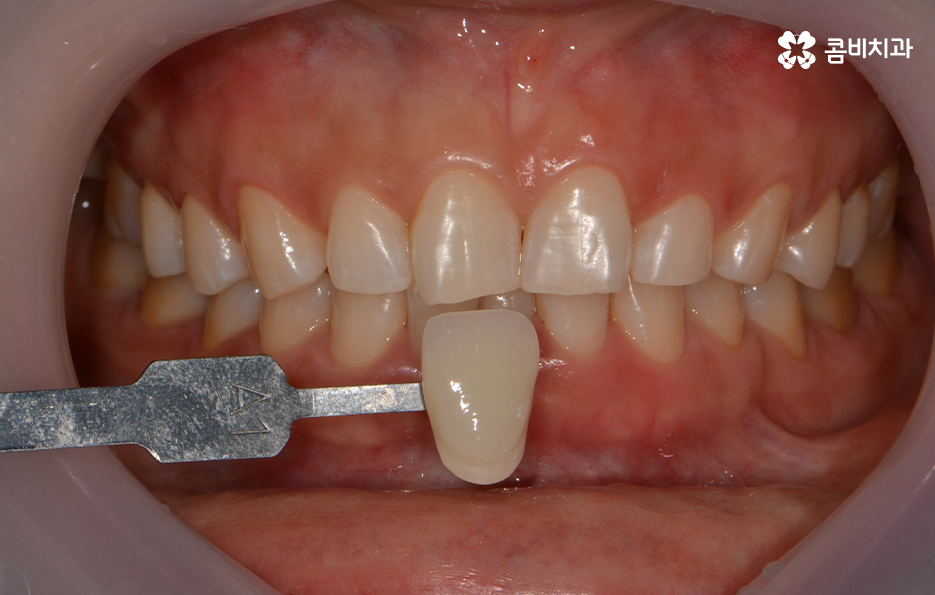 치과치아미백 어떻게 다른지 설명해드려요 관련 이미지 9