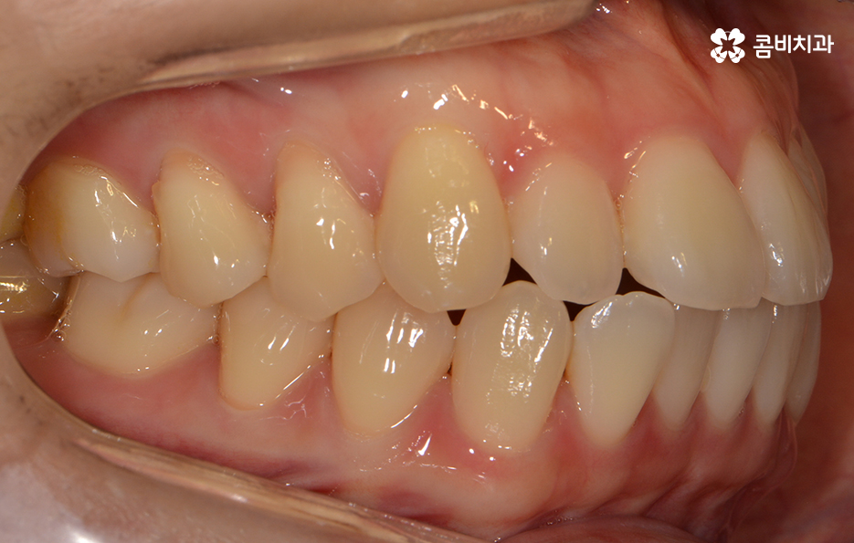 앞니치아교정 자연스러운 결과를 위해 알아둬야 할 점 관련 이미지 3