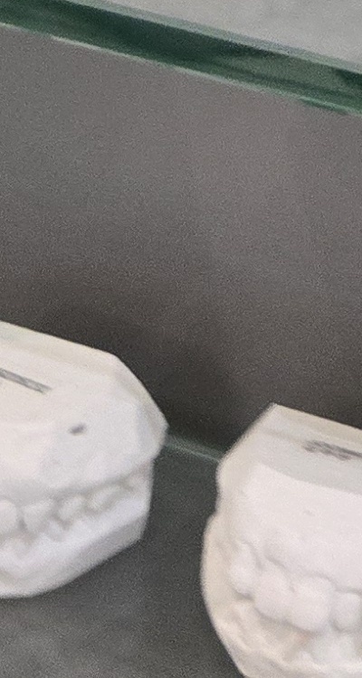 윗니 전체 임플란트 뭐부터 해야할까 관련 이미지 44