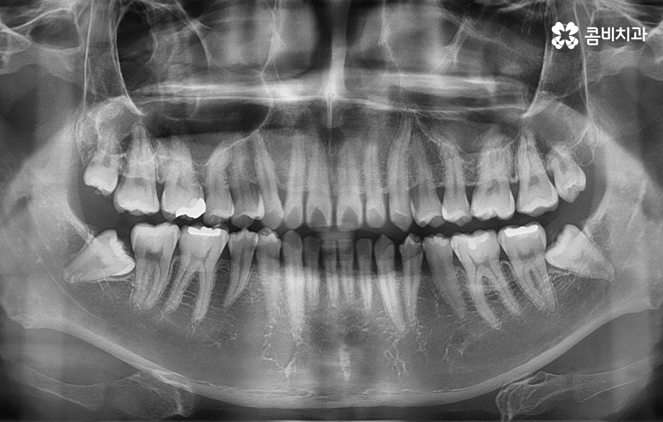 치아부분교정 내게도 적합한지 알아보려면 관련 이미지 2
