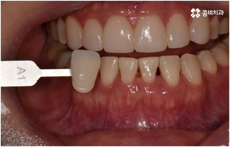 누런치아 하얗게 바꾸고 싶다면 관련 이미지 9