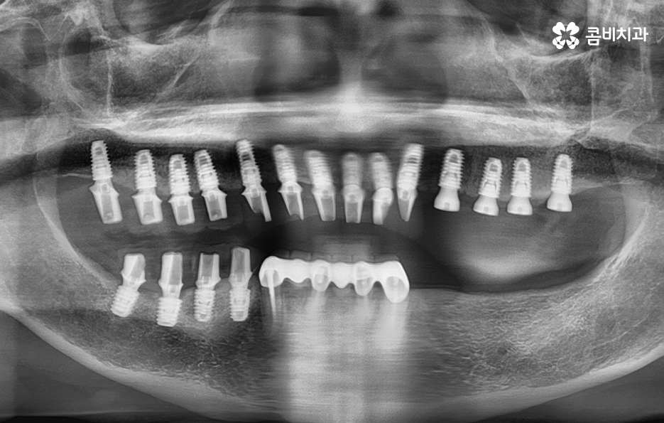 65세이상임플란트 고령이기에 간과하지 말아야 할 사항은 관련 이미지 5