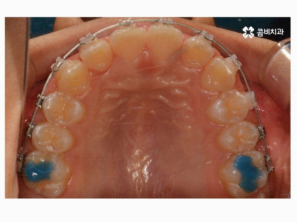 과개교합교정 어릴때 고쳐주면 좋은 사례 관련 이미지 11