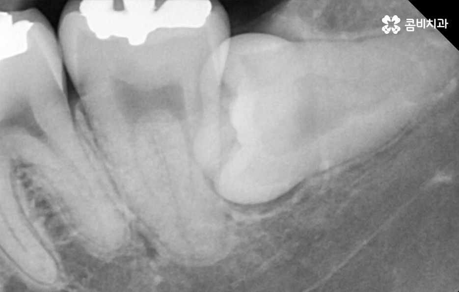 누워있는 사랑니 꼭 뽑아야 하는 경우는 언제일까 관련 이미지 3