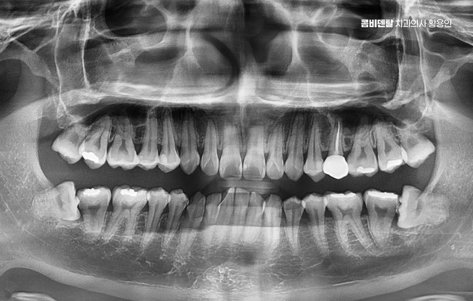 How to Systematically Prepare for Wisdom Tooth Extraction Due to Cavities image 2