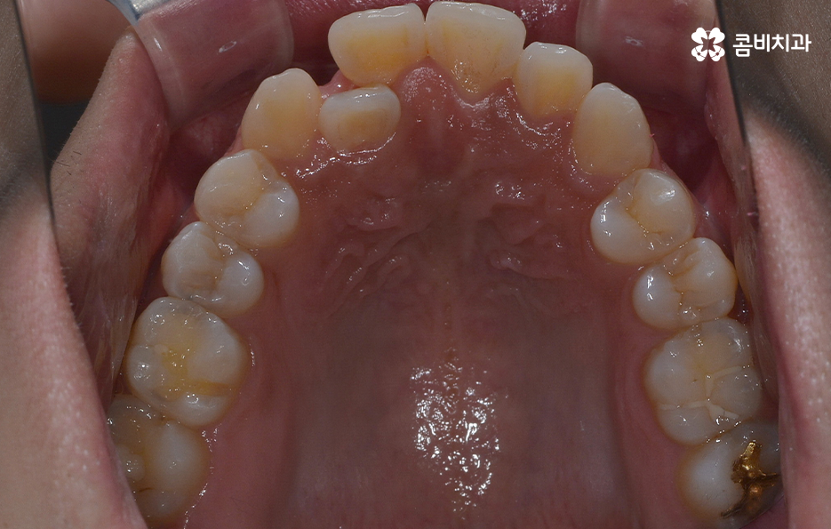 덧니 발치 교정 현명하게 선택하려면 관련 이미지 4