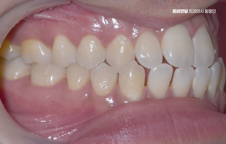 클리피씨교정 장단점 어떻게 비교하면 될까요 관련 이미지 2