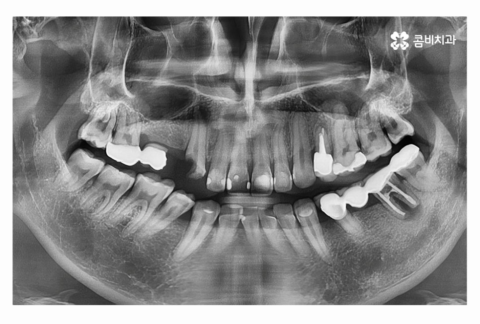 20대임플란트 갈수록 늘어나는 이유는 관련 이미지 1