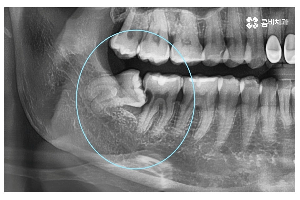 누운 사랑니 발치와 어금니신경치료를 하게 된 사례 관련 이미지 2