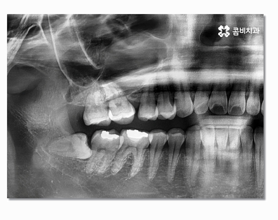 부분매복사랑니 언제 뽑아야 할까 관련 이미지 3