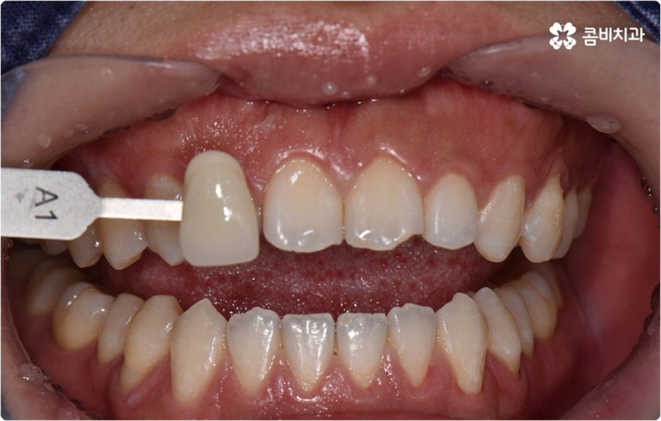 치아미백시술 관심있다면 관련 이미지 2