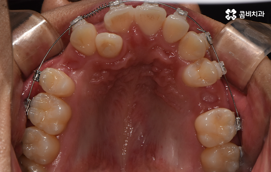 덧니 발치교정으로 교정할 때 치아가 이렇게 이동해요 관련 이미지 11