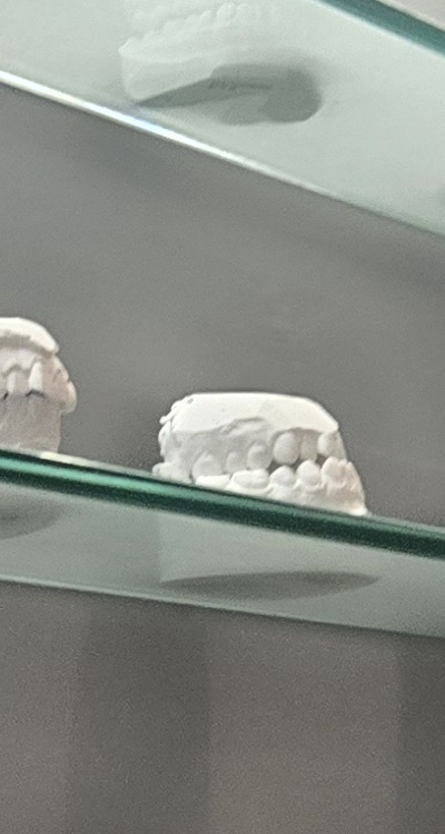 완전매복사랑니 발치 대학병원 꼭 가야하나요 관련 이미지 24