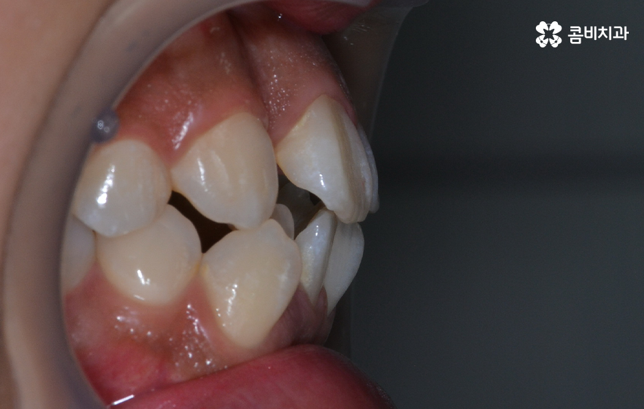 덧니 발치 교정 현명하게 선택하려면 관련 이미지 2