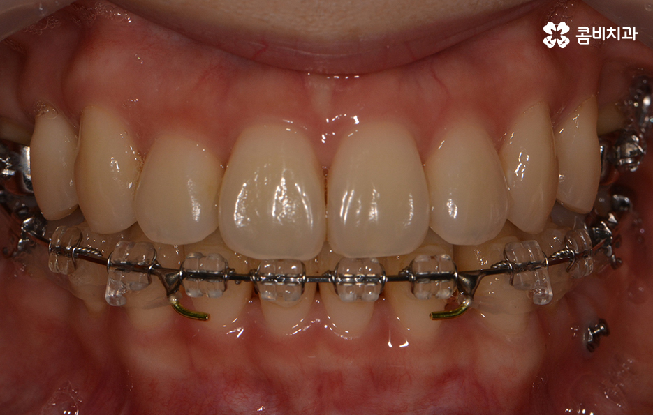 앞니치아교정 자연스러운 결과를 위해 알아둬야 할 점 관련 이미지 6