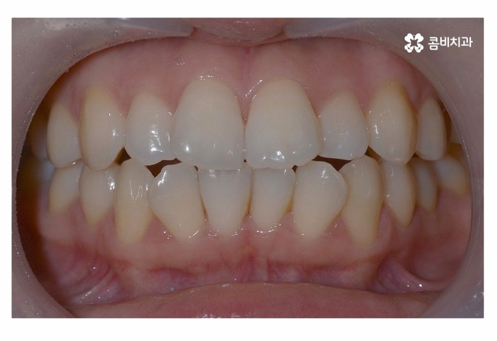 치아부분교정 나도 해당될지 궁금하다면 관련 이미지 1