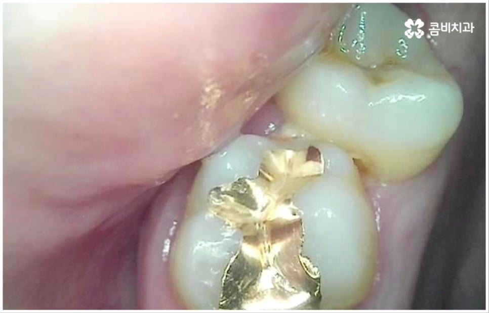충치 통증 참지마세요 관련 이미지 5