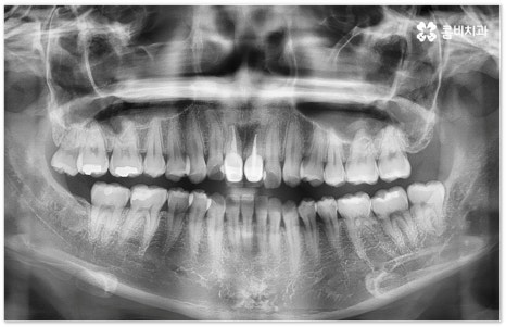 치아교정장치 어떻게 고르나요 관련 이미지 2