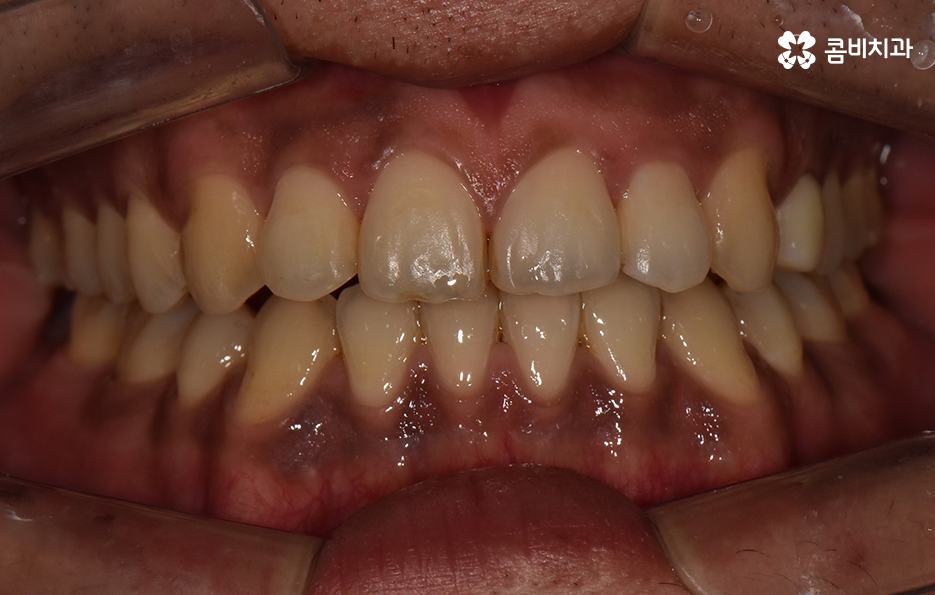 성인 부정교합 교정 더는 미루고 싶지 않다면 관련 이미지 7