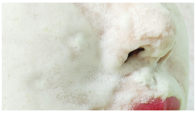 화이트헤드 제거 꿀팁공개! 관련 이미지 5