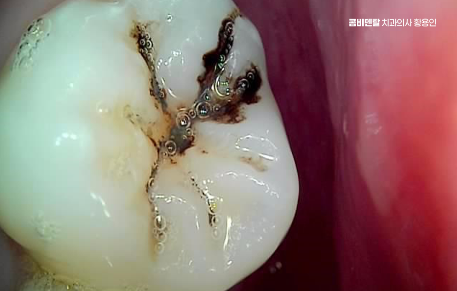 How to Systematically Prepare for Wisdom Tooth Extraction Due to Cavities image 5