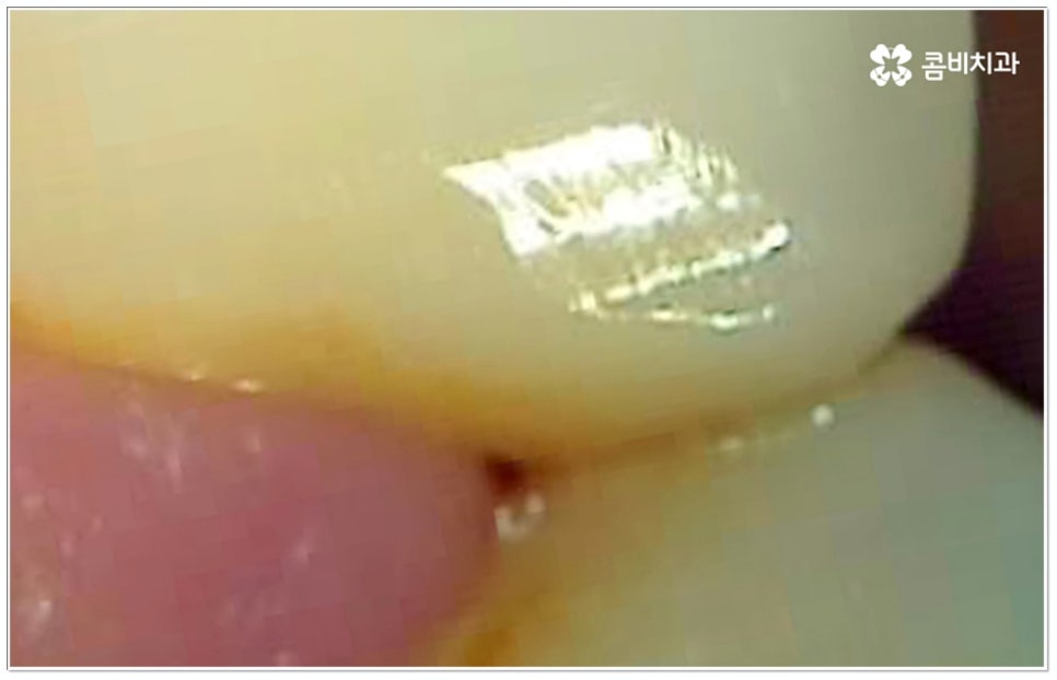 충치 인레이 언제 받나요? 관련 이미지 4
