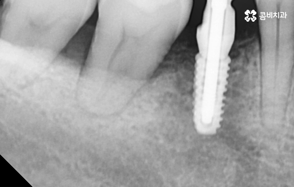 임플란트 해야 하는데 치아교정이 하고 싶다면 관련 이미지 10
