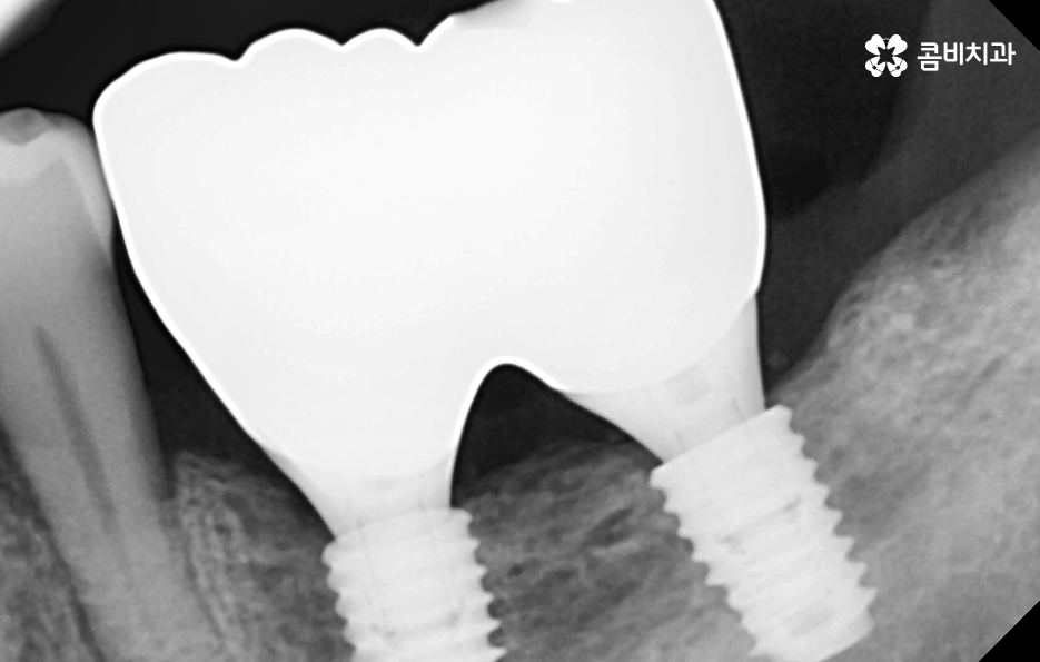 50대임플란트 각별하게 주의해야 하는 시기 관련 이미지 13