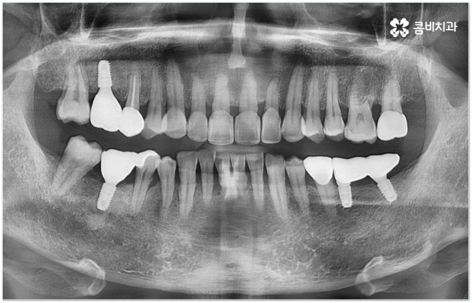 뼈이식임플란트 언제하나요? 관련 이미지 14