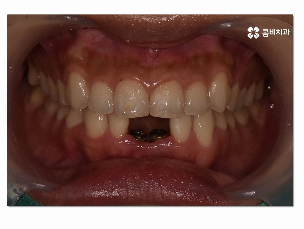 치주염으로 인한 아랫니 임플란트 절차를 알아보면 관련 이미지 1